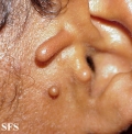 accessory tragus