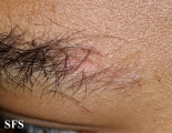 mucinosis follicular