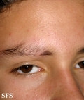 mucinosis follicular