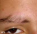 mucinosis follicular