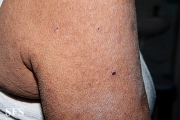 mucinosis follicular