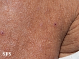 mucinosis follicular