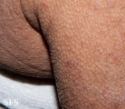 mucinosis follicular