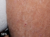 mucinosis follicular