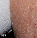mucinosis follicular