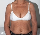 mucinosis follicular