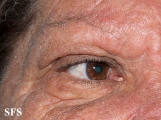 mucinosis follicular
