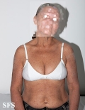 mucinosis follicular
