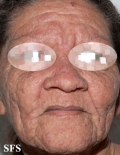 mucinosis follicular