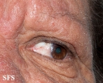 mucinosis follicular