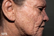mucinosis follicular