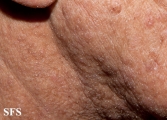 mucinosis follicular