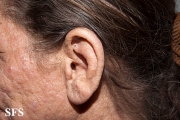 mucinosis follicular
