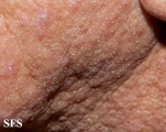 mucinosis follicular