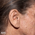 mucinosis follicular
