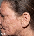 mucinosis follicular