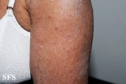mucinosis follicular