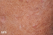 mucinosis follicular