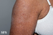 mucinosis follicular