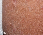 mucinosis follicular