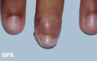 acrodermatitis continua
