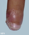 acrodermatitis continua