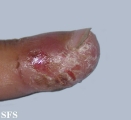 acrodermatitis continua