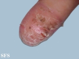 acrodermatitis continua