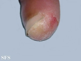 acrodermatitis continua