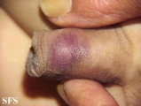 tick bite