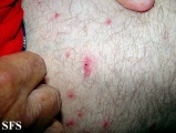 tick bite