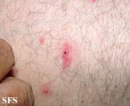 tick bite