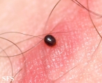 tick bite