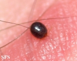 tick bite