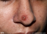 leishmaniasis-cutaneous leishmaniasis