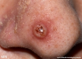 leishmaniasis-cutaneous leishmaniasis