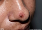 leishmaniasis-cutaneous leishmaniasis