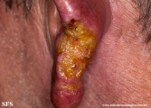 leishmaniasis-cutaneous leishmaniasis