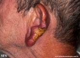 leishmaniasis-cutaneous leishmaniasis