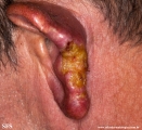 leishmaniasis-cutaneous leishmaniasis