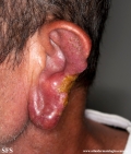 leishmaniasis-cutaneous leishmaniasis