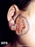 leishmaniasis-cutaneous leishmaniasis