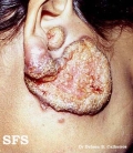 leishmaniasis-cutaneous leishmaniasis