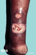 leishmaniasis-cutaneous leishmaniasis