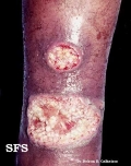 leishmaniasis-cutaneous leishmaniasis