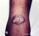 leishmaniasis-cutaneous leishmaniasis