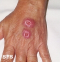 leishmaniasis-cutaneous leishmaniasis