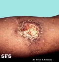 leishmaniasis-cutaneous leishmaniasis