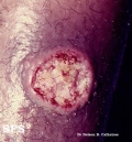 leishmaniasis-cutaneous leishmaniasis