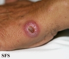 leishmaniasis-cutaneous leishmaniasis